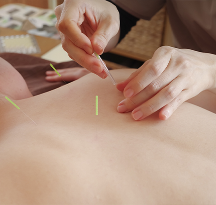 鍼灸の画像